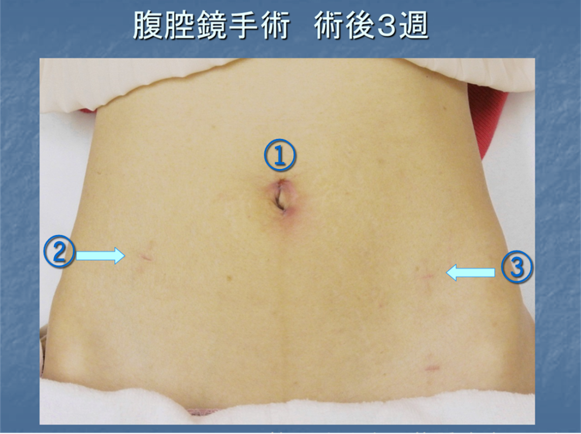 腹腔鏡手術術後3週