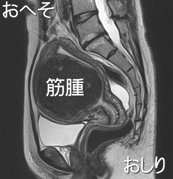9cmの筋層内筋腫のMRIの画像