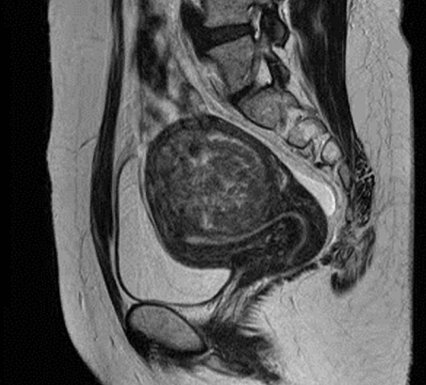 子宮鏡治療後のMRI画像