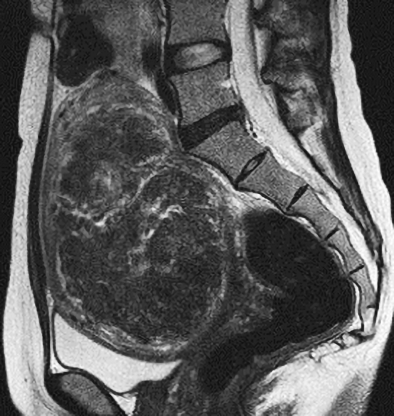 子宮鏡治療後のMRI画像