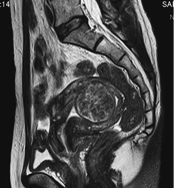 子宮鏡治療後のMRI画像